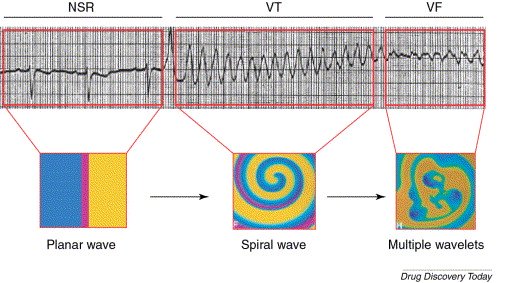 Image of ECG waves